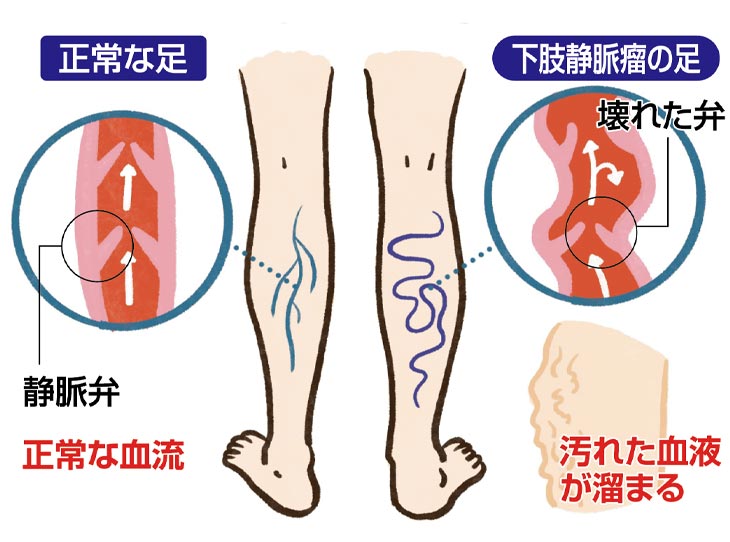 日本製 一般医療機器 下肢静脈瘤対策サポーター メディカル・レッグ同色2足4枚組